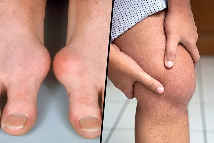 photo of gout in feet and knee comparison
