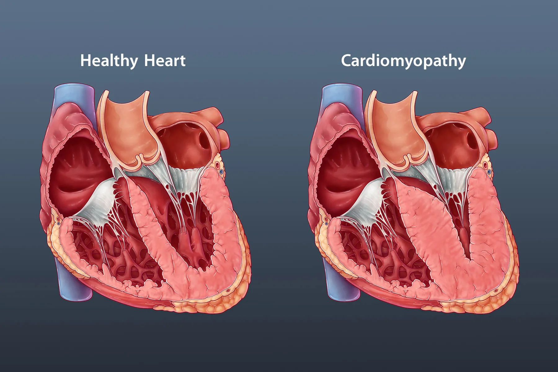 illustration of healthy heart vs. cardiomyopathy