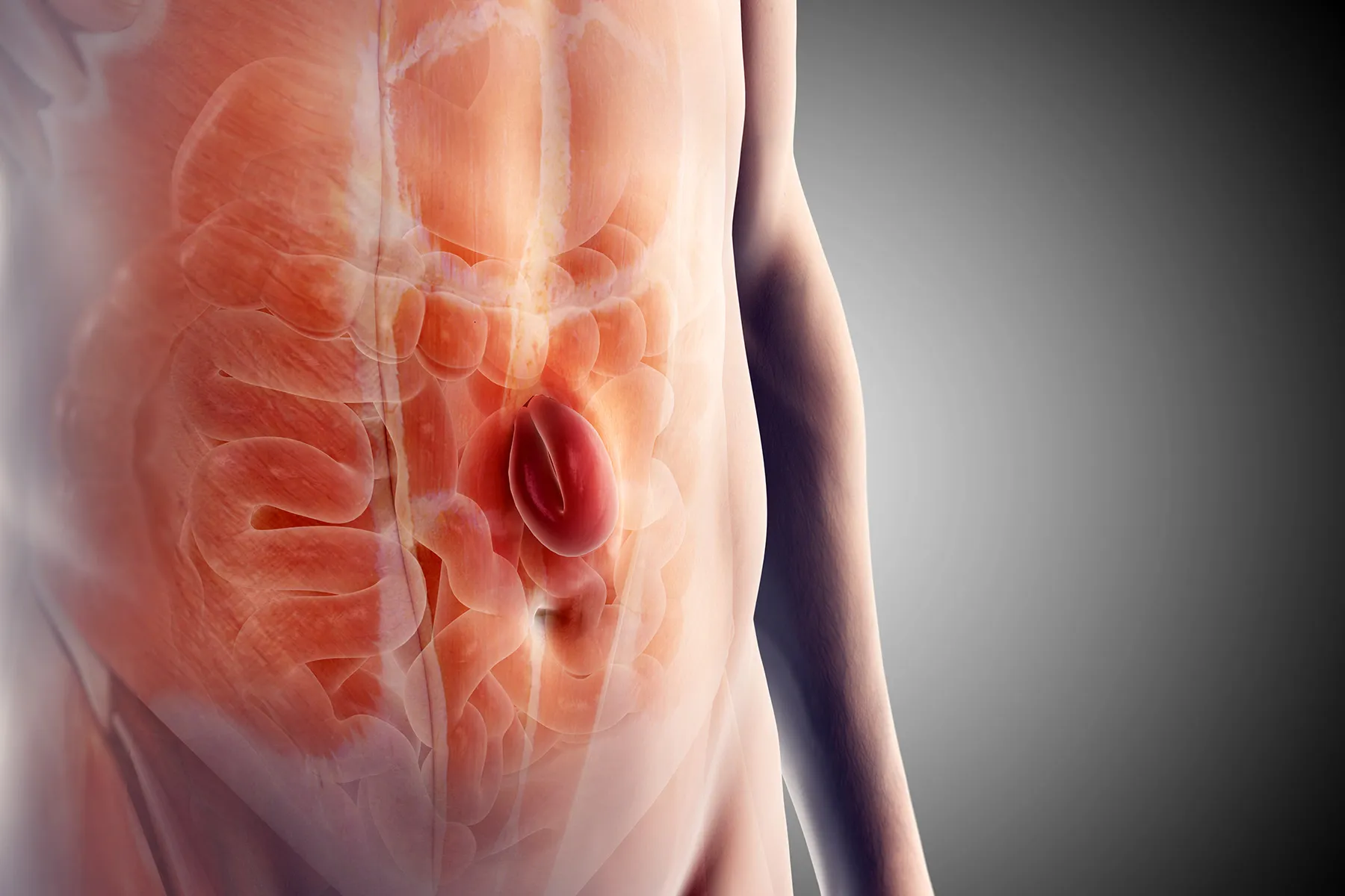 photo of ventral hernia