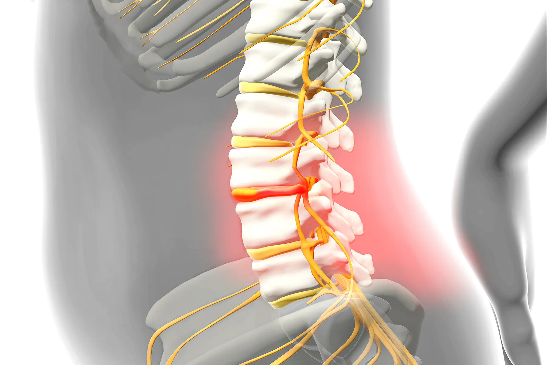 photo of human body with a prolapsed disc