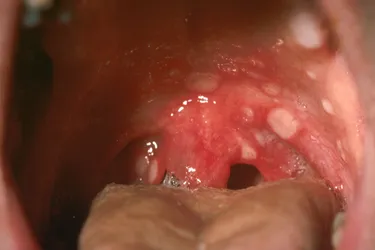 Herpangina causes small, painful blisters in your throat and mouth. (Photo credit: Medical Images BH archive)
