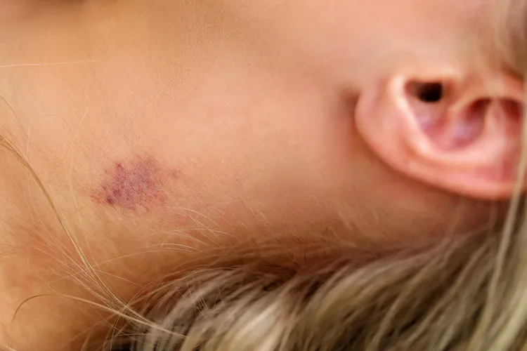 photo of Hickey or love bite