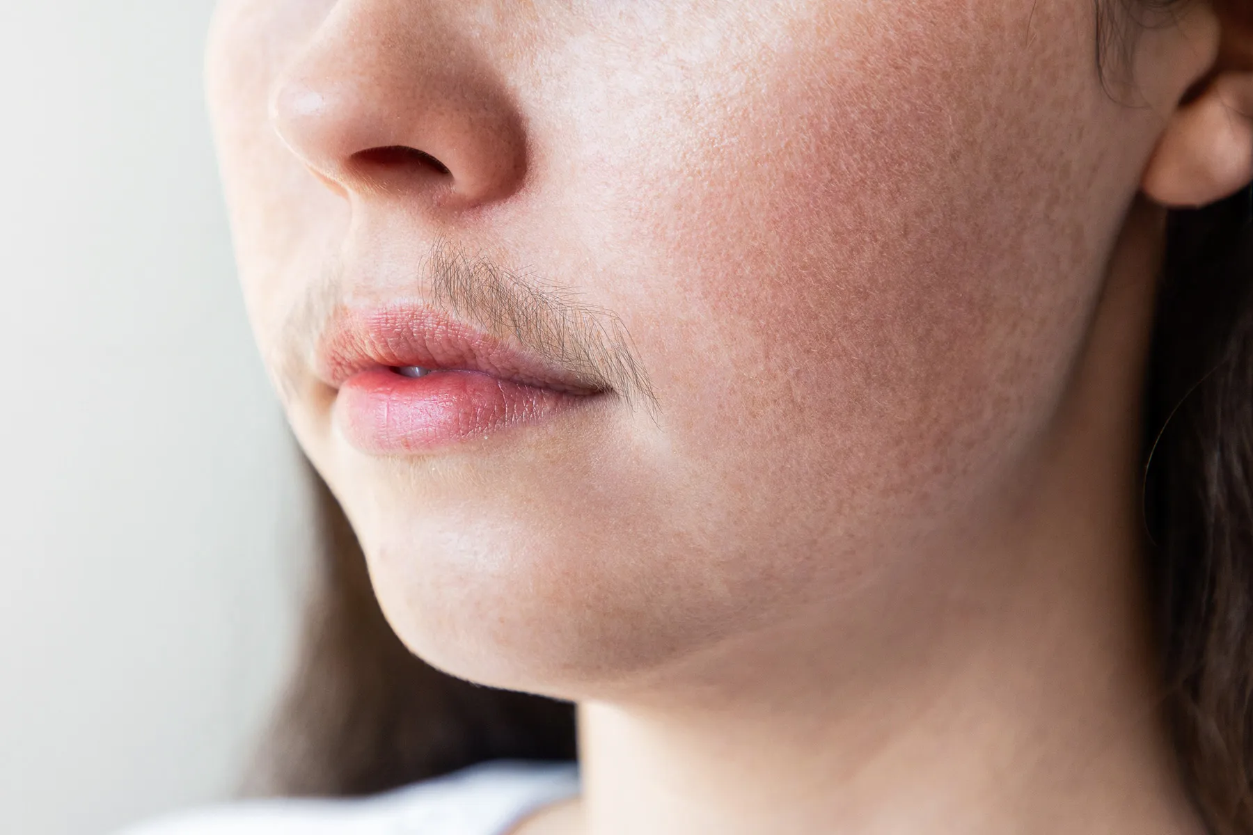 photo of hirsutism