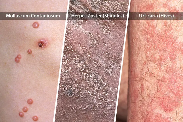 photo of three HIV skin rashes