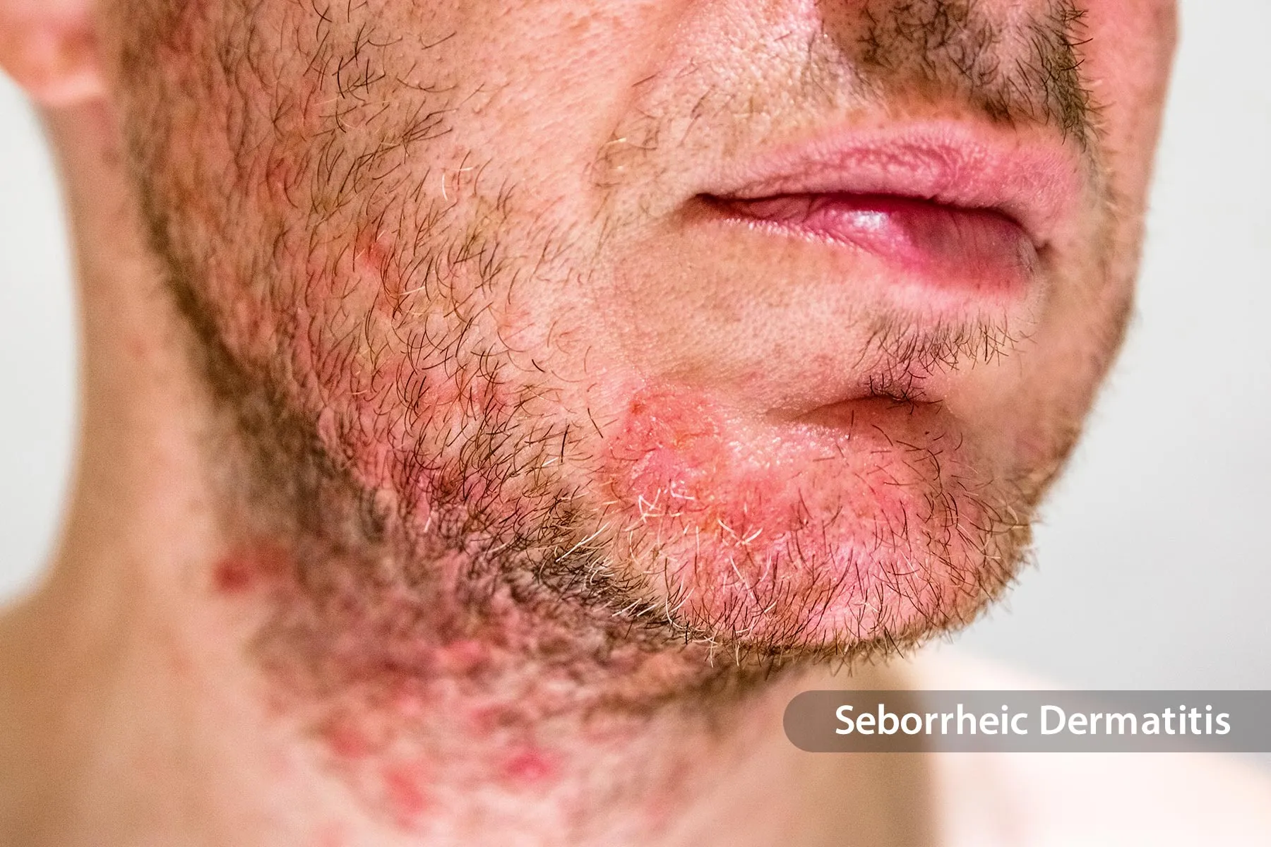 photo of seborrheic dermatitis on man's face