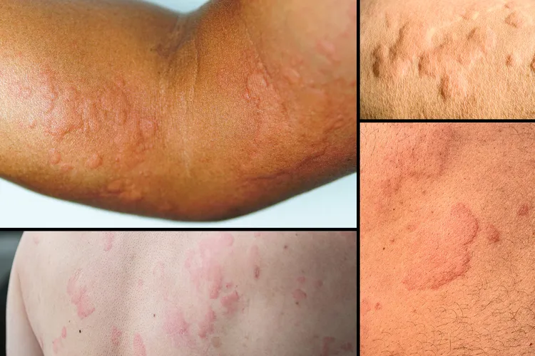 photo of Hives - Urticaria, Skin Disease 