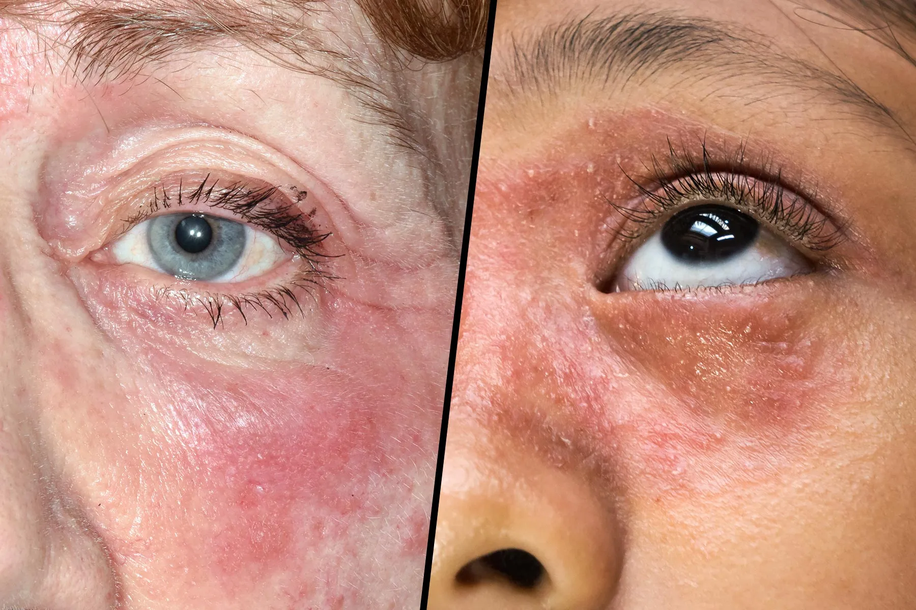 photo of facial eczema on different skin tones