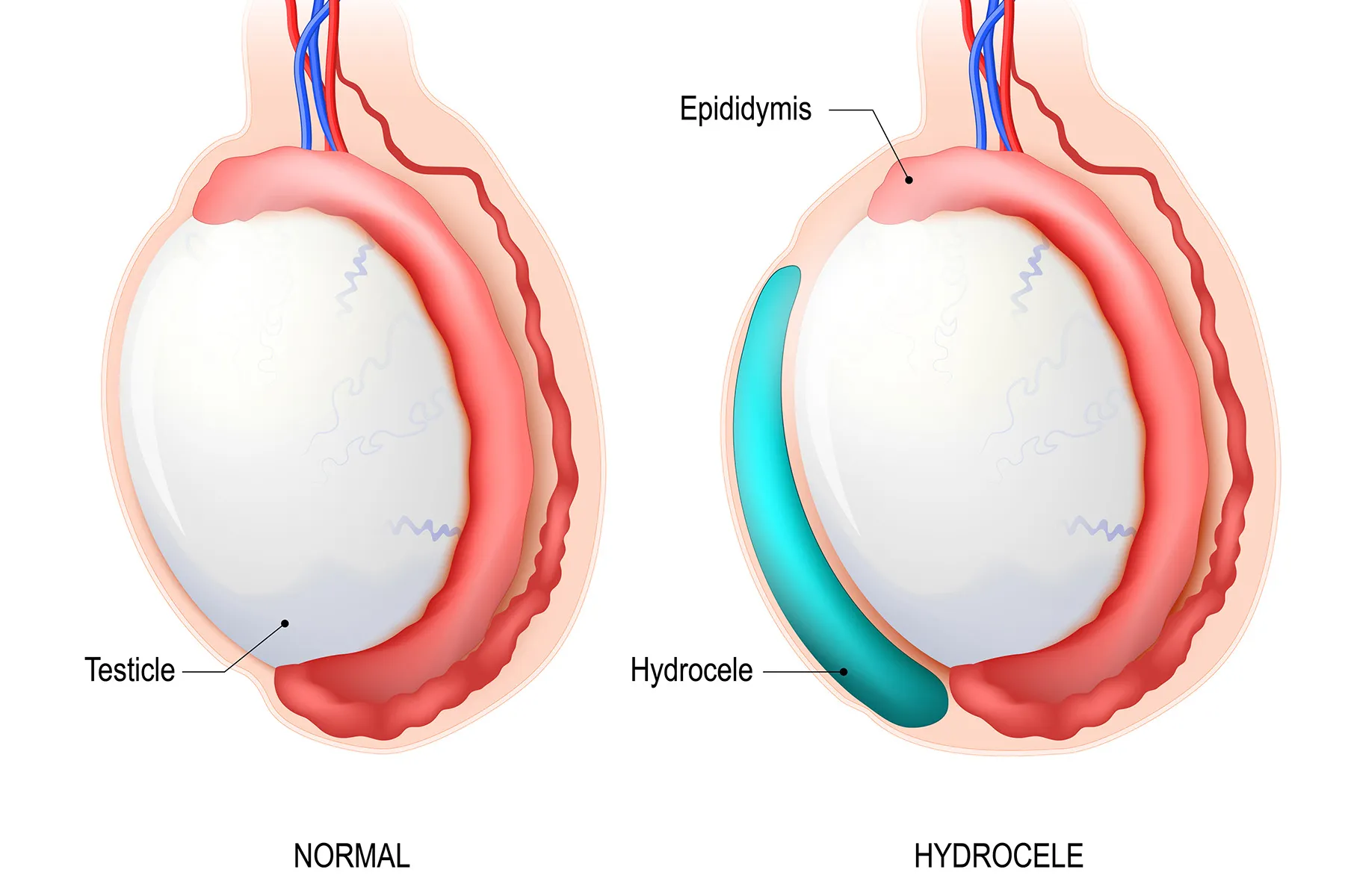 photo of hydrocele
