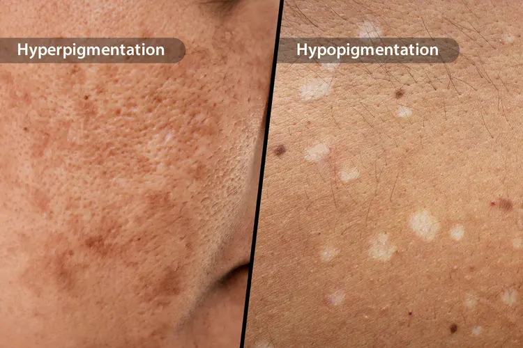 photo of hyperpigmentation and hypopigmentation comparison