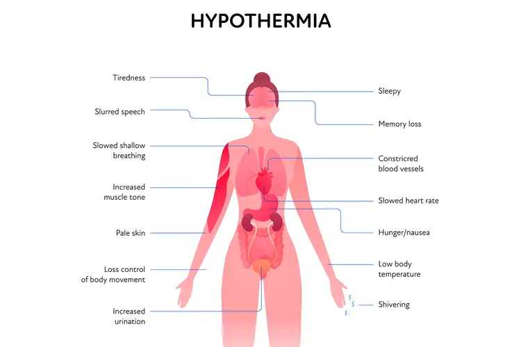 photo of hypothermia