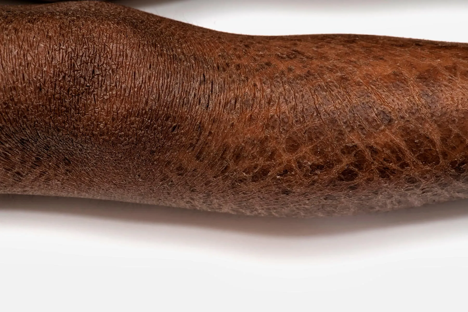 Ichthyosis Research amp Resources