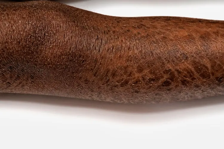 photo of ichthyosis