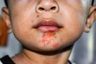 If your child gets red sores, especially around the nose and mouth, they could have impetigo. It's a skin infection caused by a bacteria, and it spreads easily. It's most common in babies and young children, but adults can get it too. (Photo credit: Zay Nyi Nyi/Dreamstime)