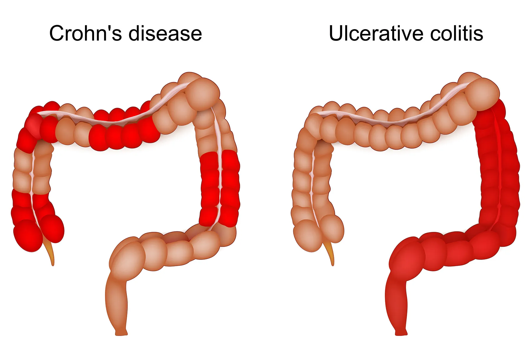 photo of uc vs crohn's disease