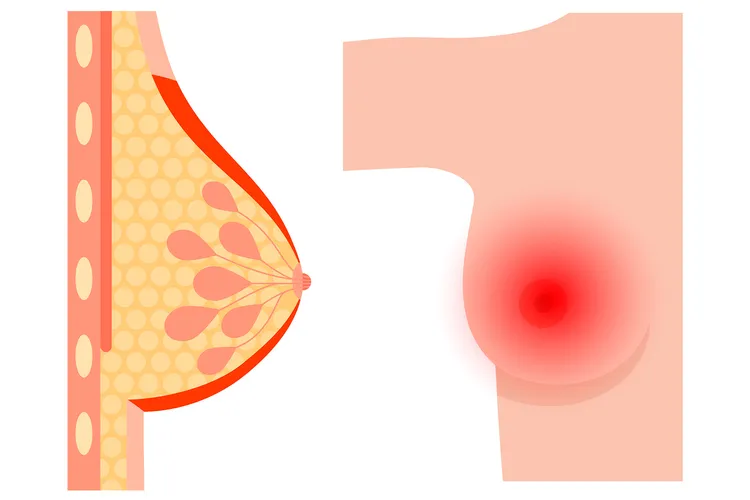photo of inflammatory breast cancer