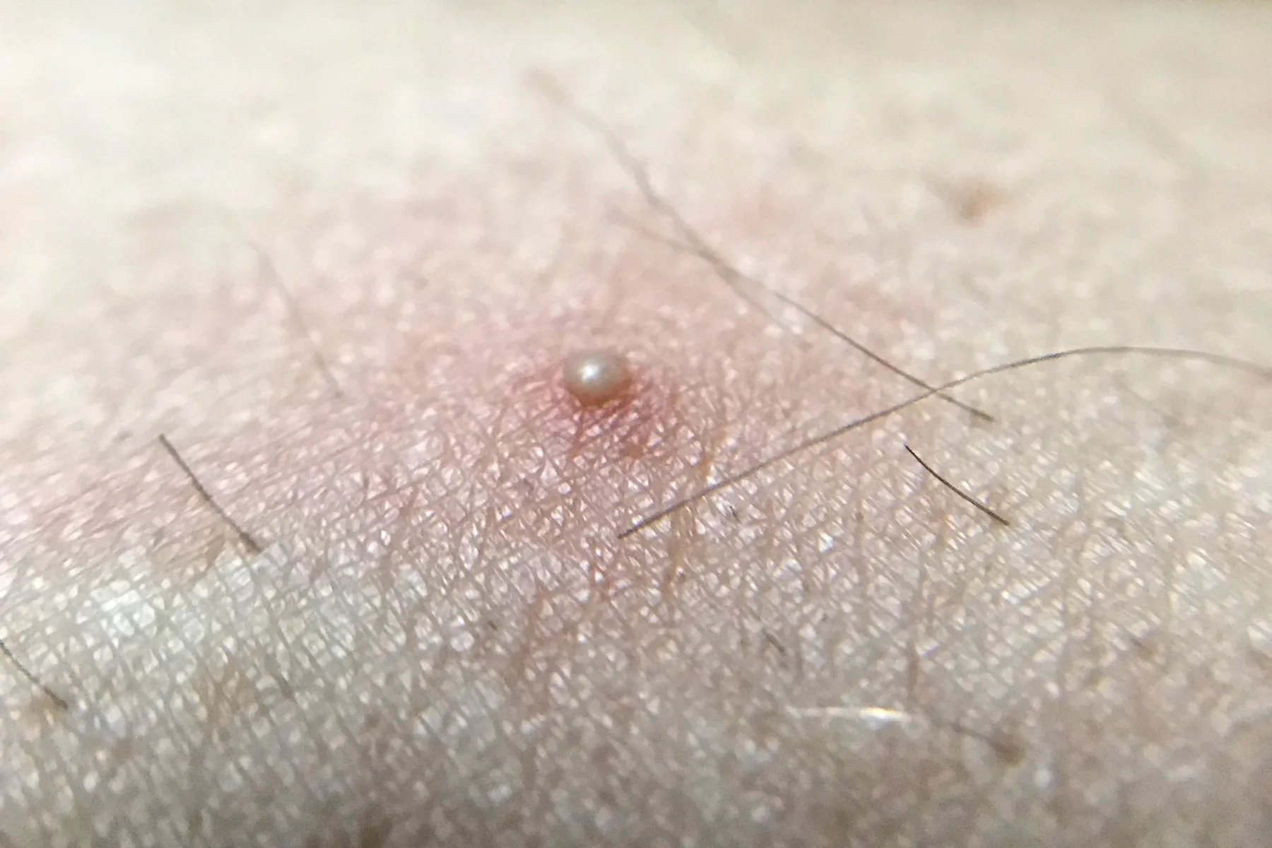 photo of ingrown hair