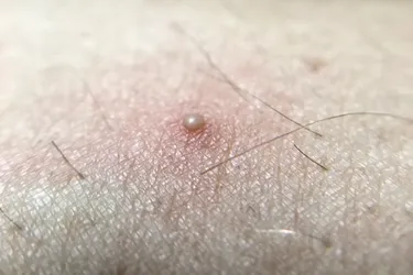Ingrown hairs can look like pimples and pop up in areas where you shave. But they can happen on other parts of your body, too. (Photo credit: Moment/Getty Images)