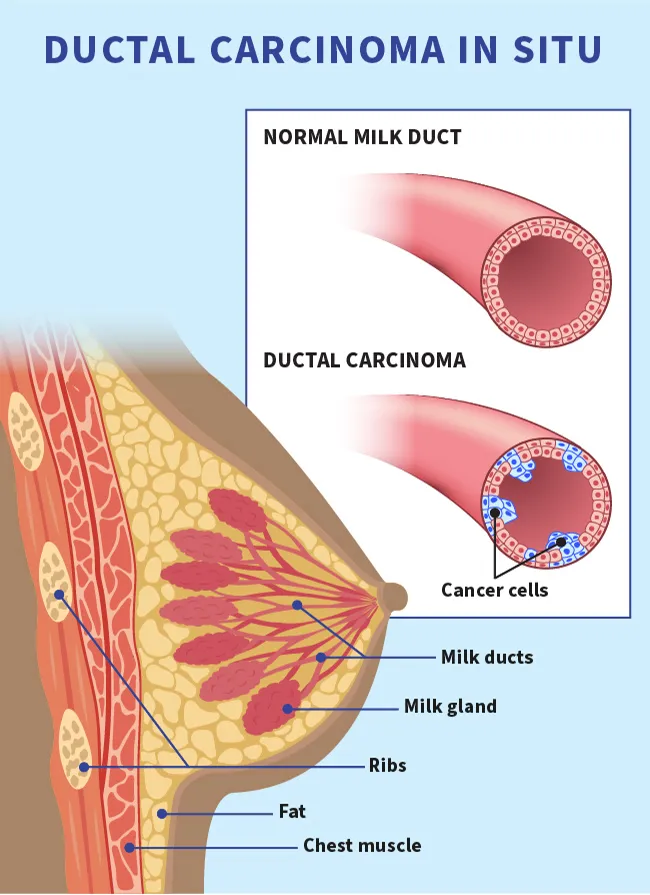 Ductal Carcinoma in Situ infographic