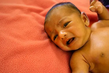The most obvious sign of jaundice is a yellow color to the skin. But that can be hard to spot in babies with darker complexions. Instead, you might look for yellow in the whites of their eyes. (Photo Credit: Arindam Ghosh/Dreamstime) 