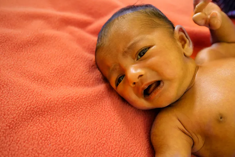 photo of jaundice baby crying