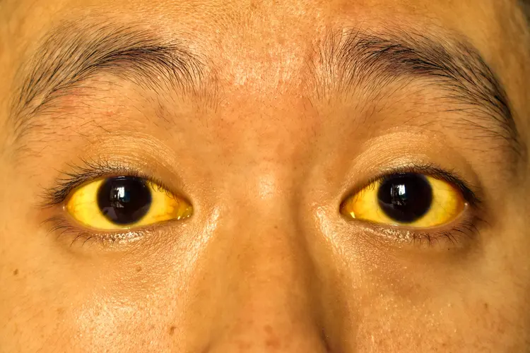 photo of Jaundice