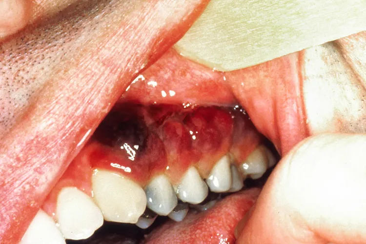 photo of Karposi's Sarcoma in mouth