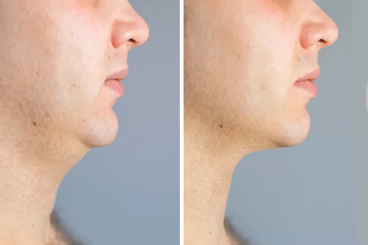 photo of neck lift before-and-after