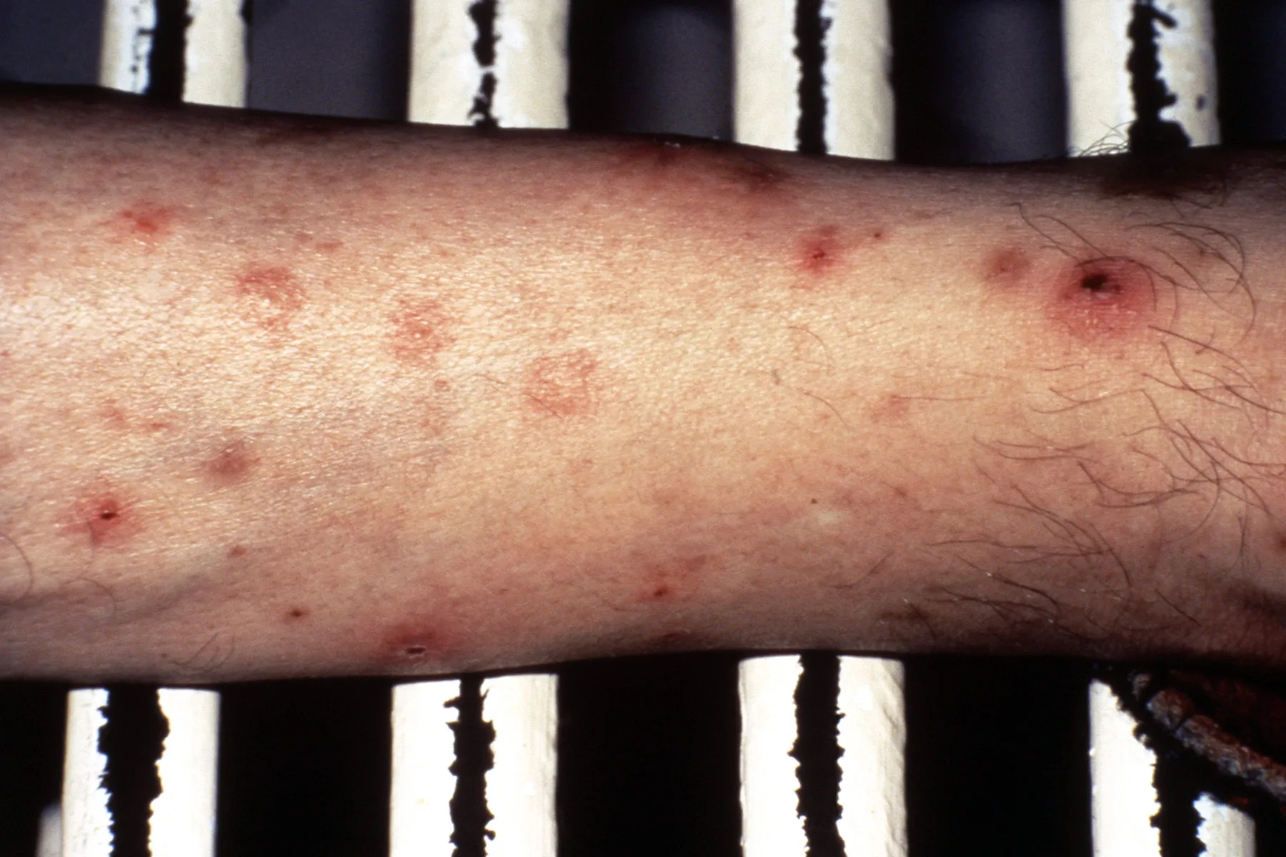photo of lymphoid leukemia bruising