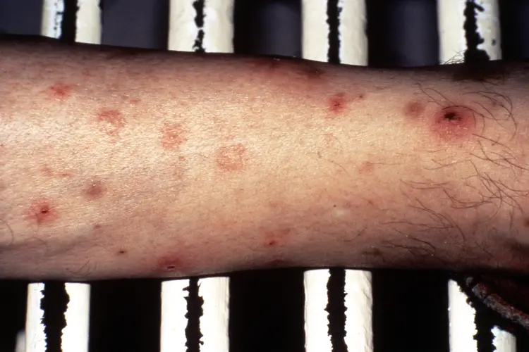 photo of lymphoid leukemia bruising