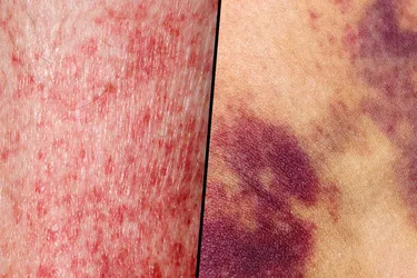 Red spots, or petechiae, can be an early sign of leukemia. Usually, they aren't itchy or painful. (Photo Credit: DR P. MARAZZI/Science Source)