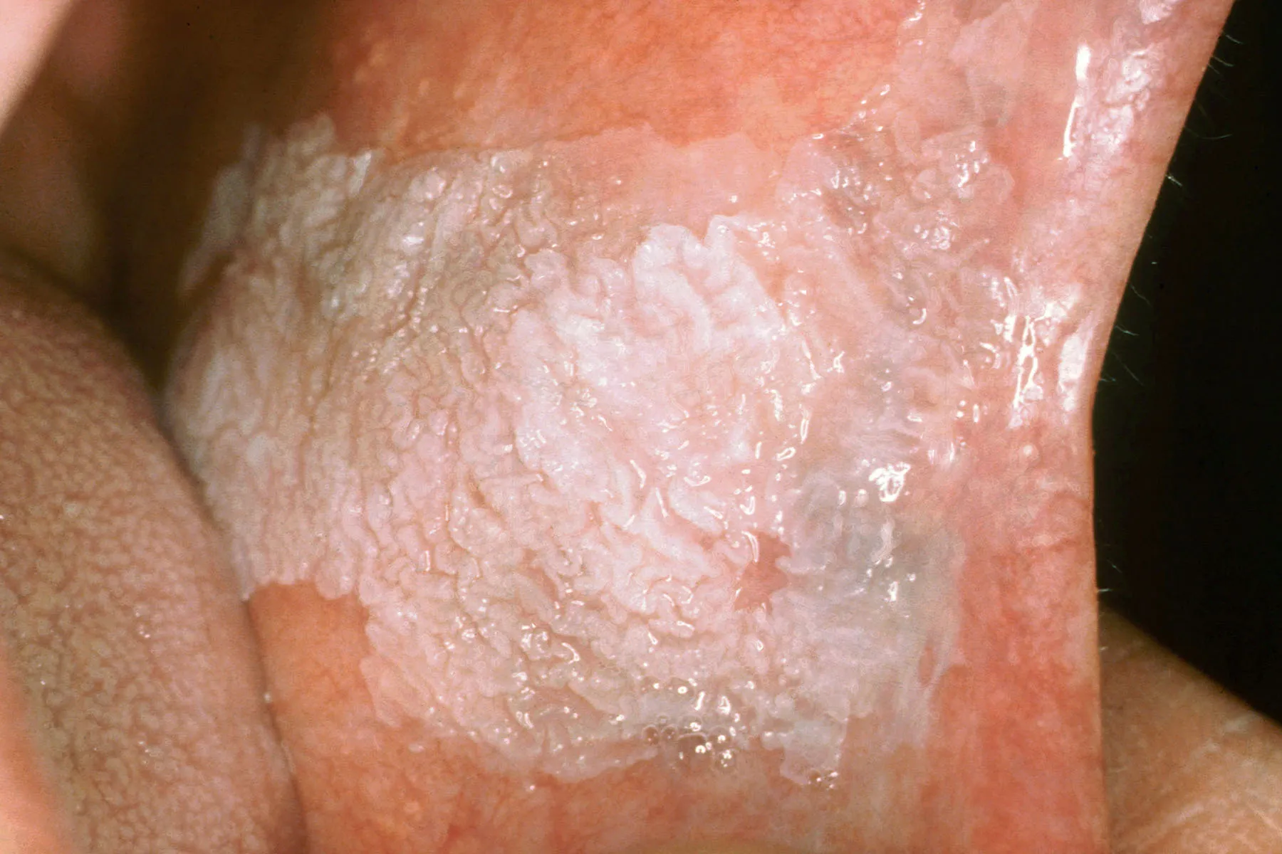 photo of leukoplakia