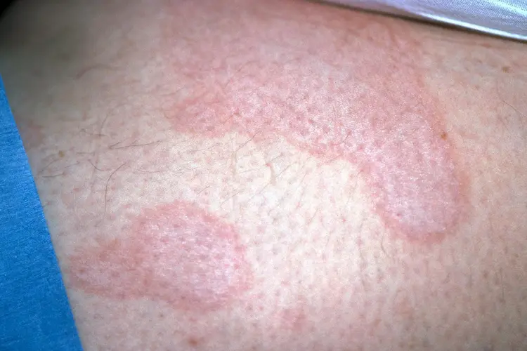photo of Lichen sclerosus