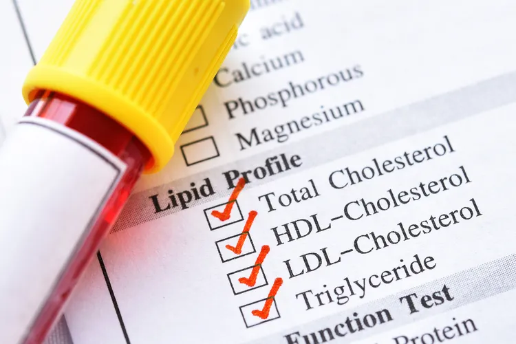 photo of lipid panel test