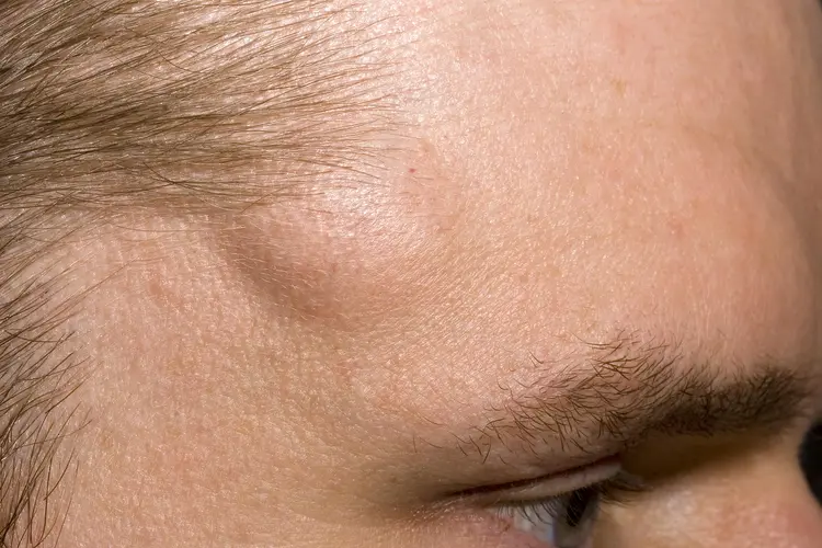 photo of lipoma on man's temple