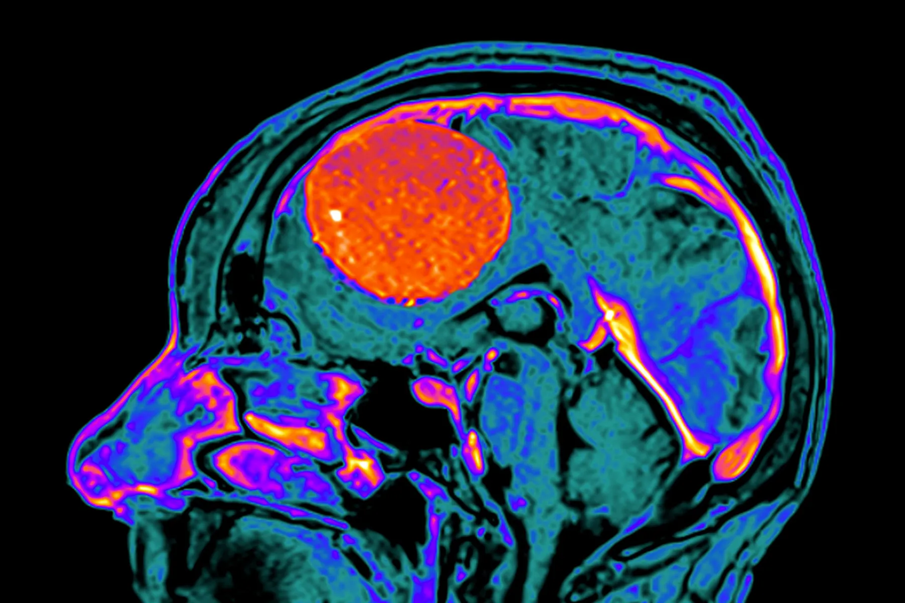 photo of meningioma brain tumor