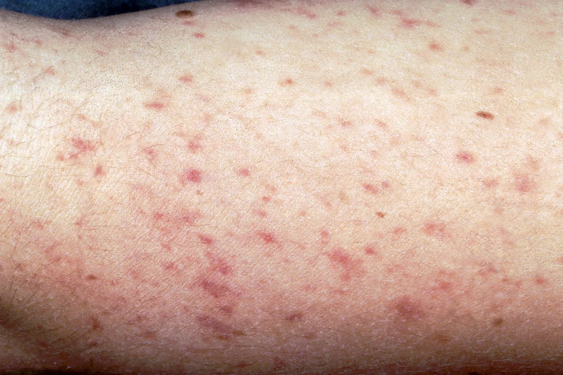 photo of meningitis skin rash