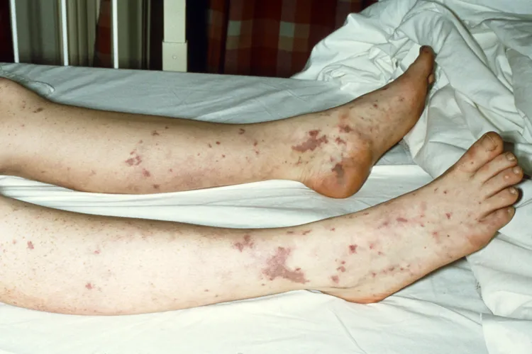 photo of meningitis rash