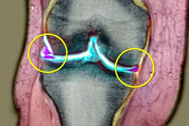 This MRI shows a knee meniscus tear in the two purple areas that are circled. (Photo Credit: SPL/Medical Images)
