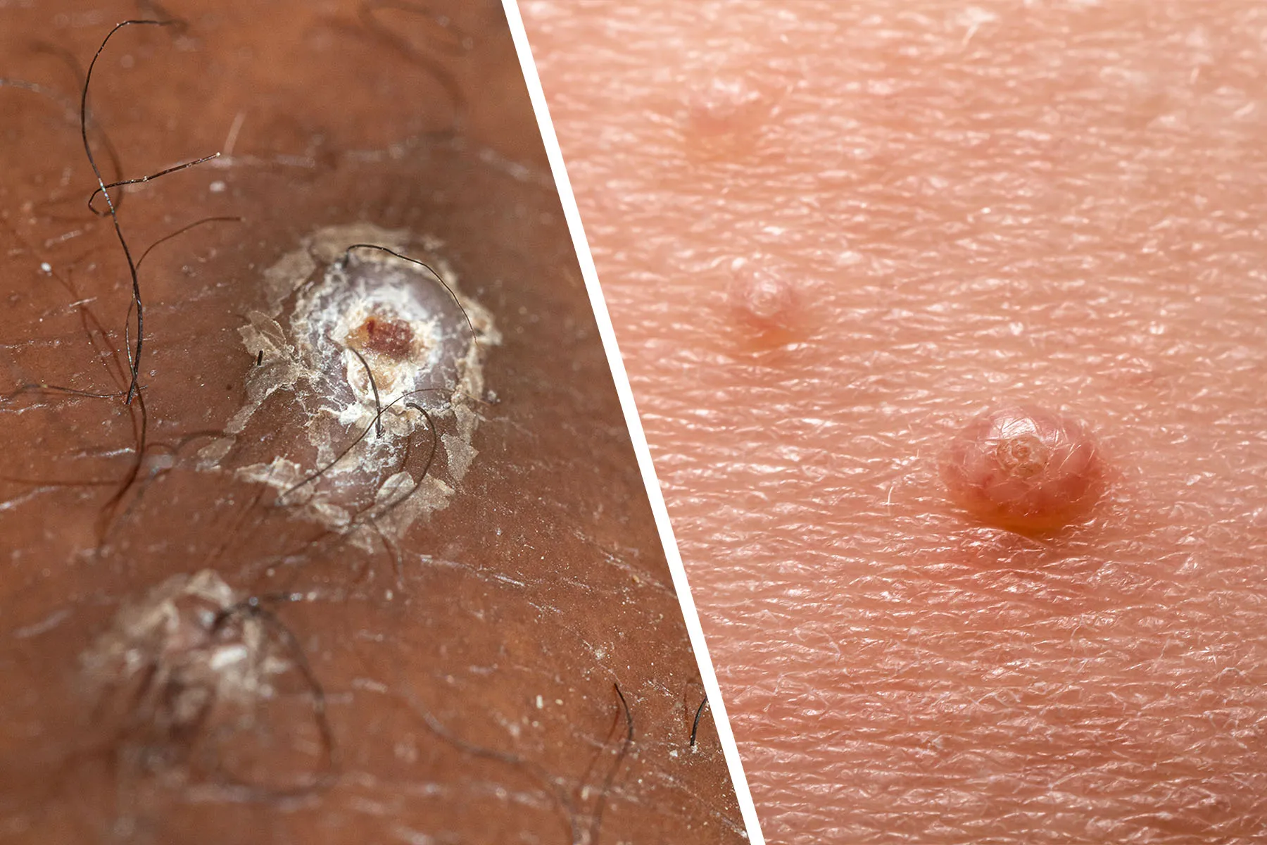 photo of molluscum contagiosum