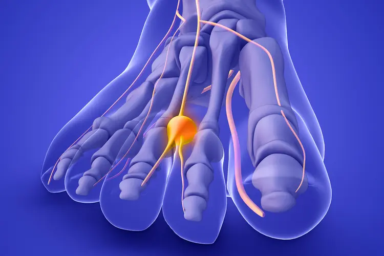 photo of morton's neuroma