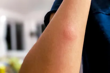 A mosquito bite is a red, itchy bump you get when a mosquito bites your skin and its saliva gets into your blood. Saliva from a mosquito triggers an allergic reaction that causes the area of the bite to become red, itchy, and swollen. (Photo credit: Moment/Getty Images)