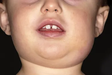 Mumps causes painful swelling in your face. There's no cure, so managing symptoms to prevent complications is key. (Photo Credit: Dr P. Marazzi/Science Source)