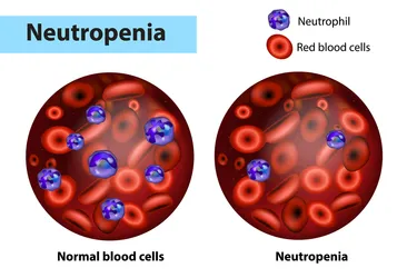 Neutropenia is a condition that happens when you have an unusually low number of cells called neutrophils, which are a type of white blood cell, in your blood. Having a lower than normal number of neutrophils in your blood can make it harder to fight germs and prevent infections. (Photo credit: Viktoriia Kasyanyuk/Dreamstime)