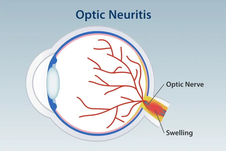 illustration of optic neuritis
