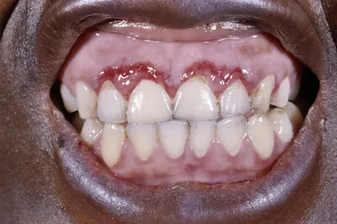 Red patches on your gums can signal oral cancer. (Photo Credit: Dr. M.A. Ansary/Science Source)