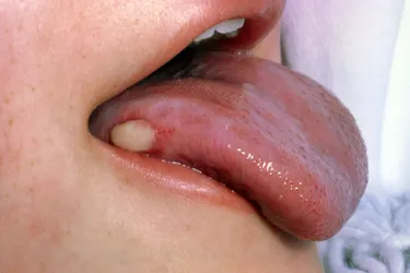 Oral cancer on your tongue or on the inside of your cheeks or lips can look like a canker sore. (Photo Credit: John Radcliffe Hospital/Science Source)