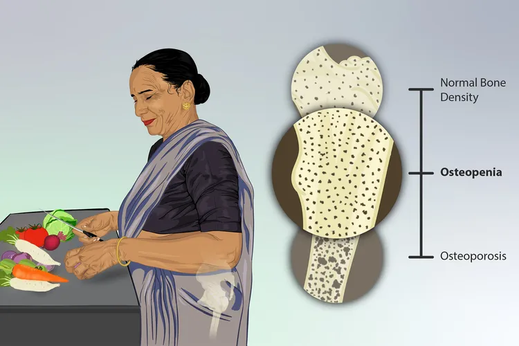 illustration of woman suffering from osteopenia