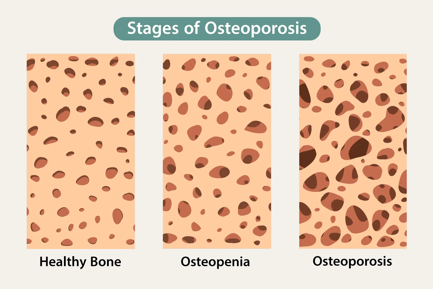 Stages of Osteoporosis infographic