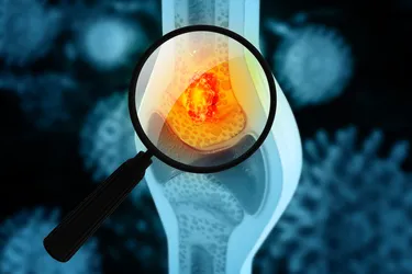 Children and adults can get osteosarcoma, the most common type of bone cancer. Treatment can be very effective if the cancer is caught early, so it's important to know its risk factors and symptoms. (Photo Credit: iStock/Getty Images)