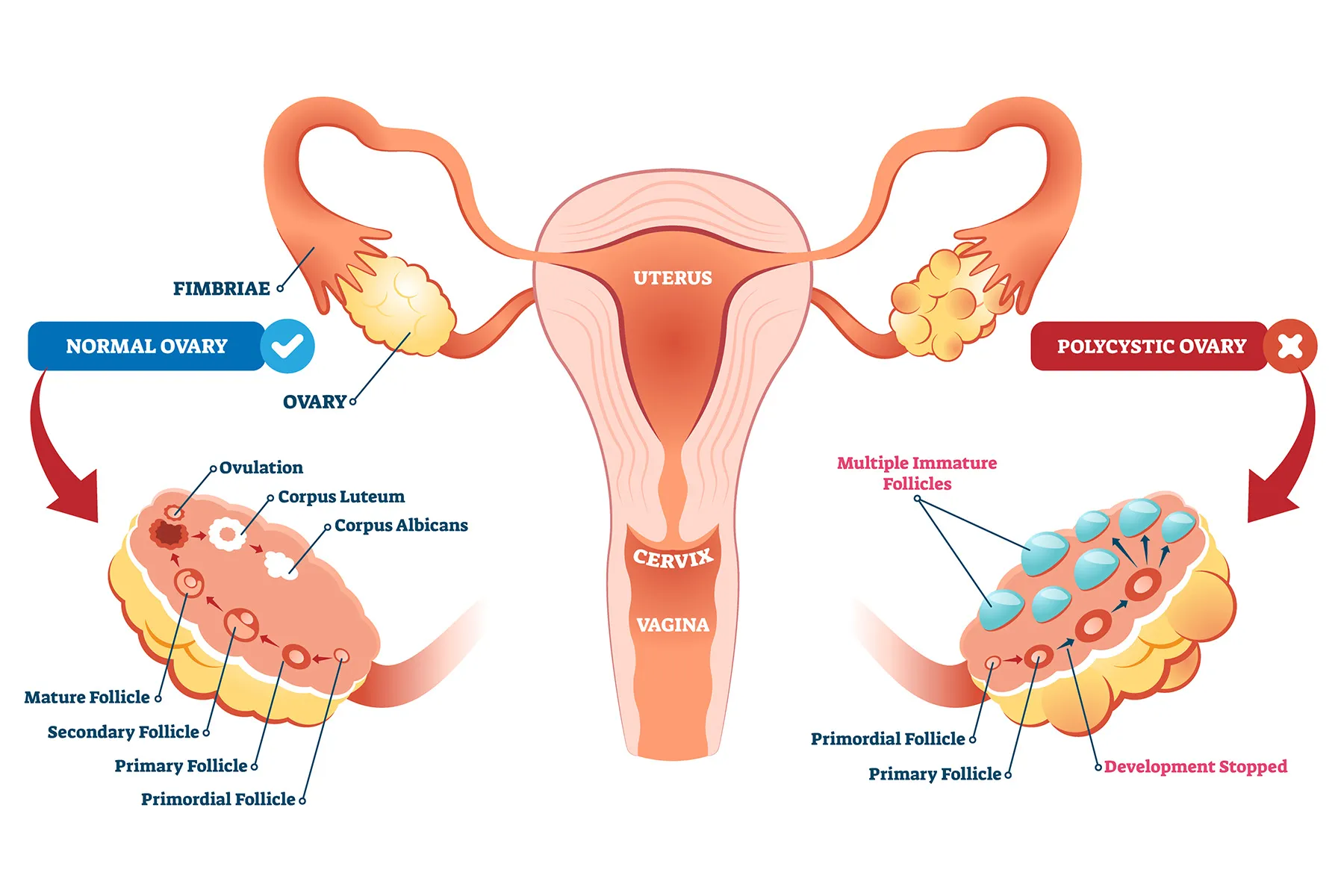 photo of pcos